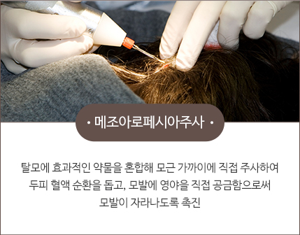 차이의원 탈모치료